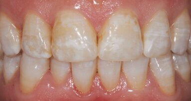 Remineralisatie: een preventieve en therapeutische benadering bij harde weefsels