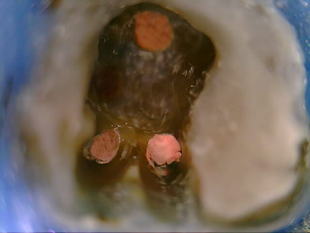 Fig. 3: Obturation of root canals.