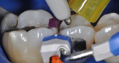 Restauro interprossimale diretto di un elemento 1.5 con il sistema Composi-Tight 3D Fusion™