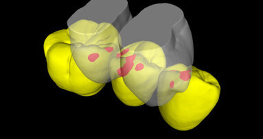 Zahnabnutzung Ursache für Zahnhalsdefekte