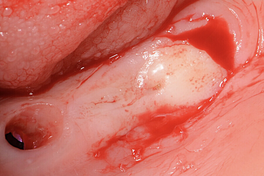 Fig.3 : Incision des bords du lambeau et désépithélialisation.