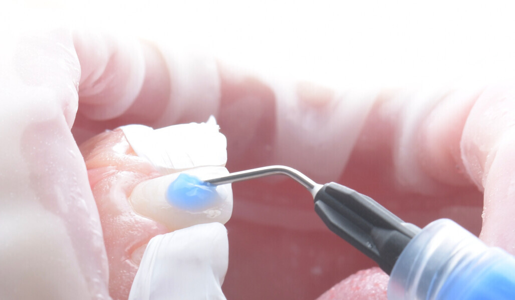 Fig. 5: Phosphoric acid etching. Adjacent teeth protected with PTFE tape.