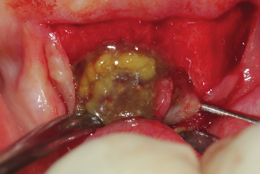 Figure 22: Inter operative view after reflection of mucoperiosteal flap, showing the extended amount of bone loss with intralesional secretion bulging outside the bone cavity. 