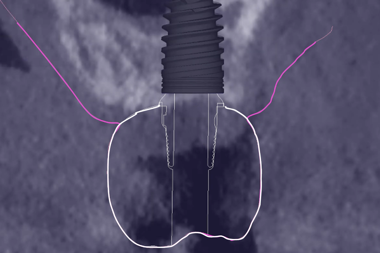 Fig. 5d: Merging of the STL file of the implant according to its height.