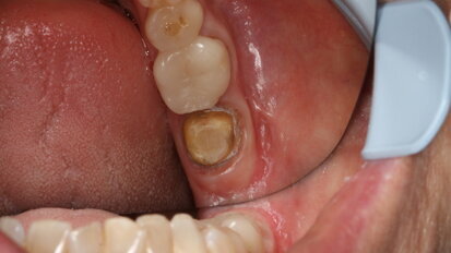 Scan perfectly with CEREC Primescan and gain time for what is really important: your patients Scan perfectly with CEREC Primescan and gain time for what is really important: your patients