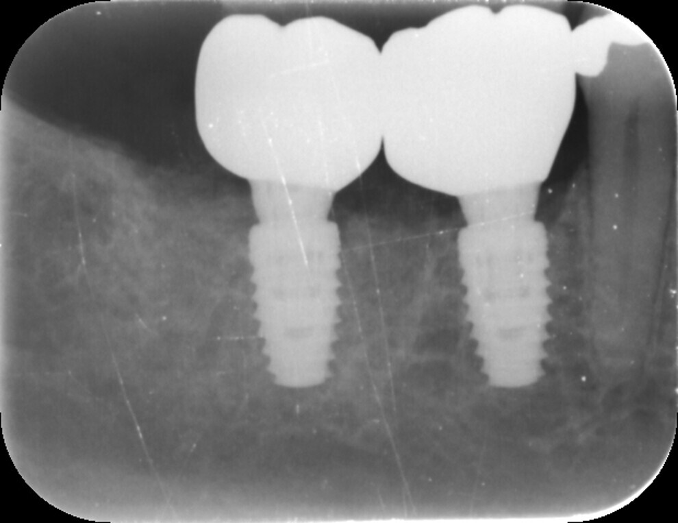 Fig. 16: Post-restoration radiograph.