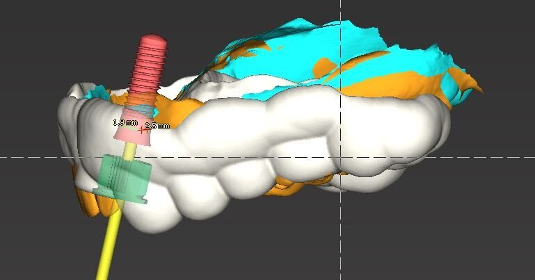 Fig. 11_Il dettaglio descritto dalla visione laterale con in bianco la forma della dima chirurgica in giallo il wax-up in rosso l’impianto in Zirconia e in verde la sleeve, cioè la cannula, che verrà posizionata nella dima per il passaggio delle frese calibrate e supportate da appositi supporti calibrati. È evidente la possibilità di far cadere nella porzione palatale il foro per l’avvitamento delle corone.