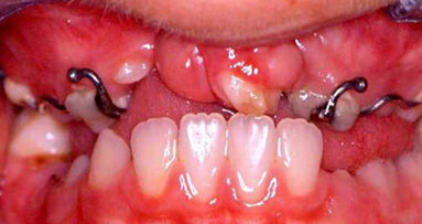 La figura dell’ortodontista nei pazienti con labiopalatoschisi