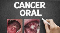 Cómo prevenir la mortalidad del cáncer oral