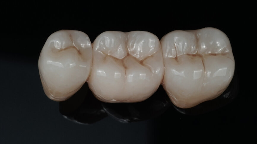 Fig. 10: Appearance of the bridge after two glaze firings.