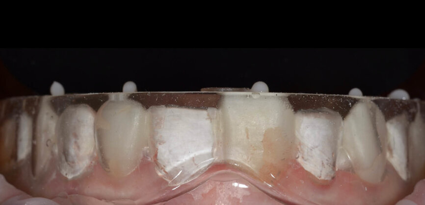 Fig. 10: Using the “Treat one, skip one” protocol, several teeth were restored simultaneously by injecting CLEARFIL MAJESTY ES Flow Low into the silicone mould. 