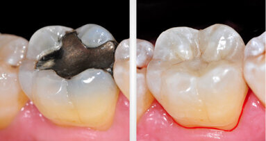 Effizienter Einsatz chromoadaptiver Komposite im Praxisalltag