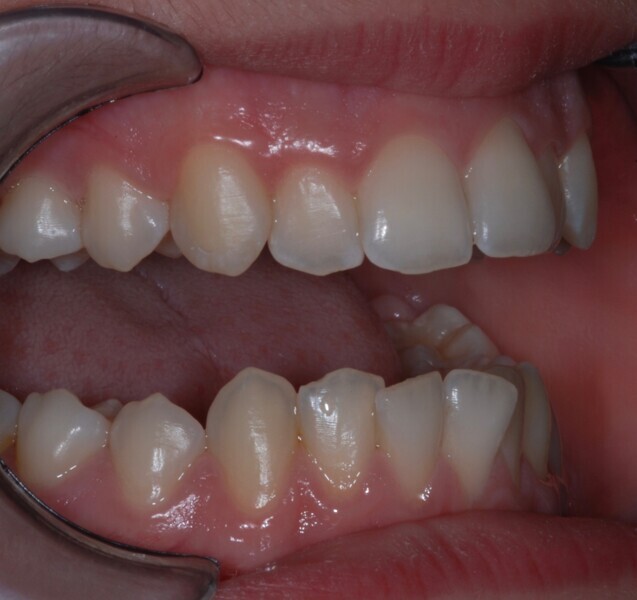 Fig. 37: Right side view with the teeth apart before treatment.