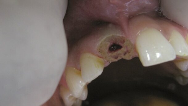 Osteointegracja przy pomocy lasera diodowego w implantacji natychmiastowej