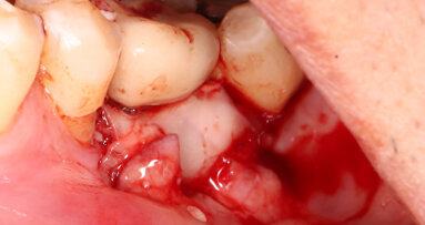 3D printing is not the perfect answer to periodontal regeneration, but it is getting close