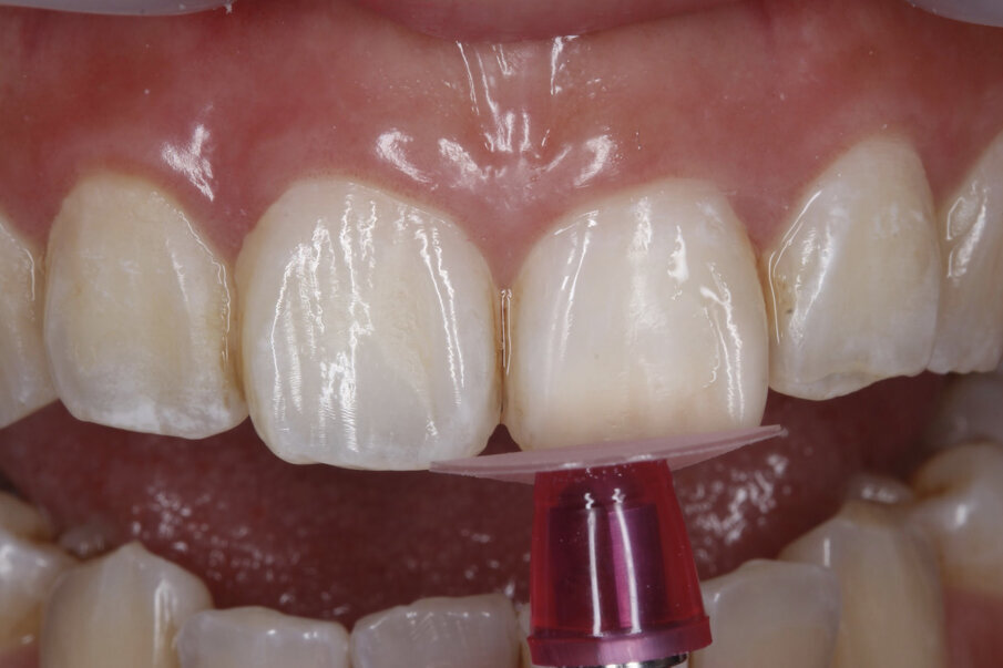 Fig 12: final polish achieved with Super-Snap Xtreme red disk