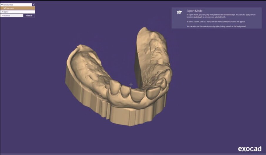 Figg. 21-25_Progettazione Cad con exocad.