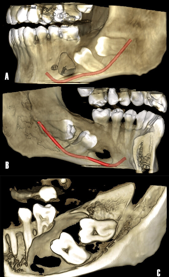 Figura 4. ReconstrucciÃ³n tridimensional a partir de TCHC. A) Vista de la afectaciÃ³n de la cortical vestibular en el tercer cuadrante, nÃ³tese la proximidad del nervio dentario inferior. B) Vista de la afectaciÃ³n de la cortical lingual. C) La extensiÃ³n antero posterior de la lesiÃ³n osteolÃ­tica ha producido la rizÃ³lisis de las raÃ­ces del primer molar y segundo premolar.