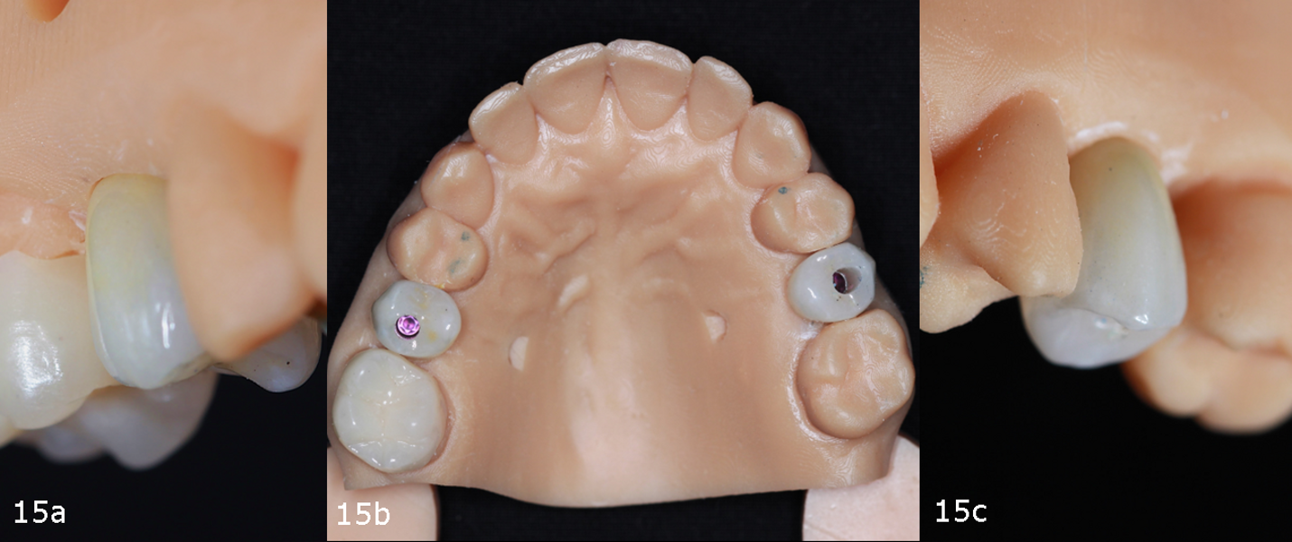 Figs. 15a–c: Definitive restorations on the 3D-printed model.