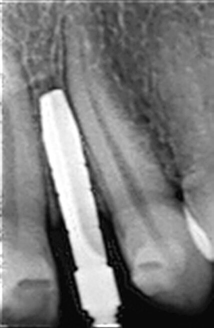 Fig. 7 : Présentation radiologique de la technique d’ouverture de l’espace interradiculaire. Il faut noter l’insertion des alésoirs manuels de 2,5 mm et 3,0 mm entre les racines, afin de préparer l’espace pour l’implant de Ø 3,0 mm, mis en place à 3,0 mm sous le niveau de l’os crestal.
