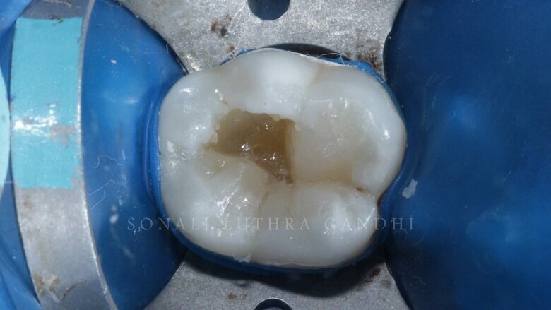 Fig 11: Mesio-lingual Cusp