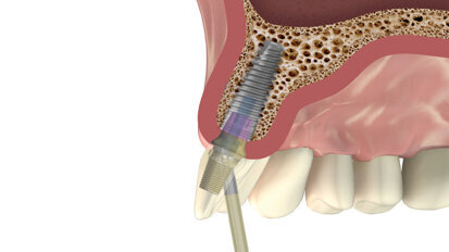 MIS releases new EZ-Base abutment