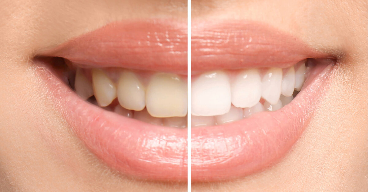 Biocompatible powder whitens teeth without peroxide damage