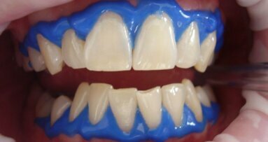 'Tanden bleken' populairste zoekopdracht