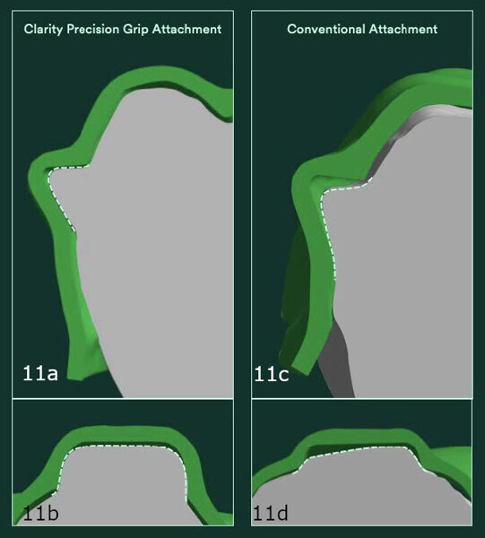 Figs. 11a–d: Cross-sectional views of bonded attachments. (a & b) More precise fit of the Clarity Precision Grip Attachment and (c & d) more pronounced gap and misalignment of the conventionally moulded attachment.