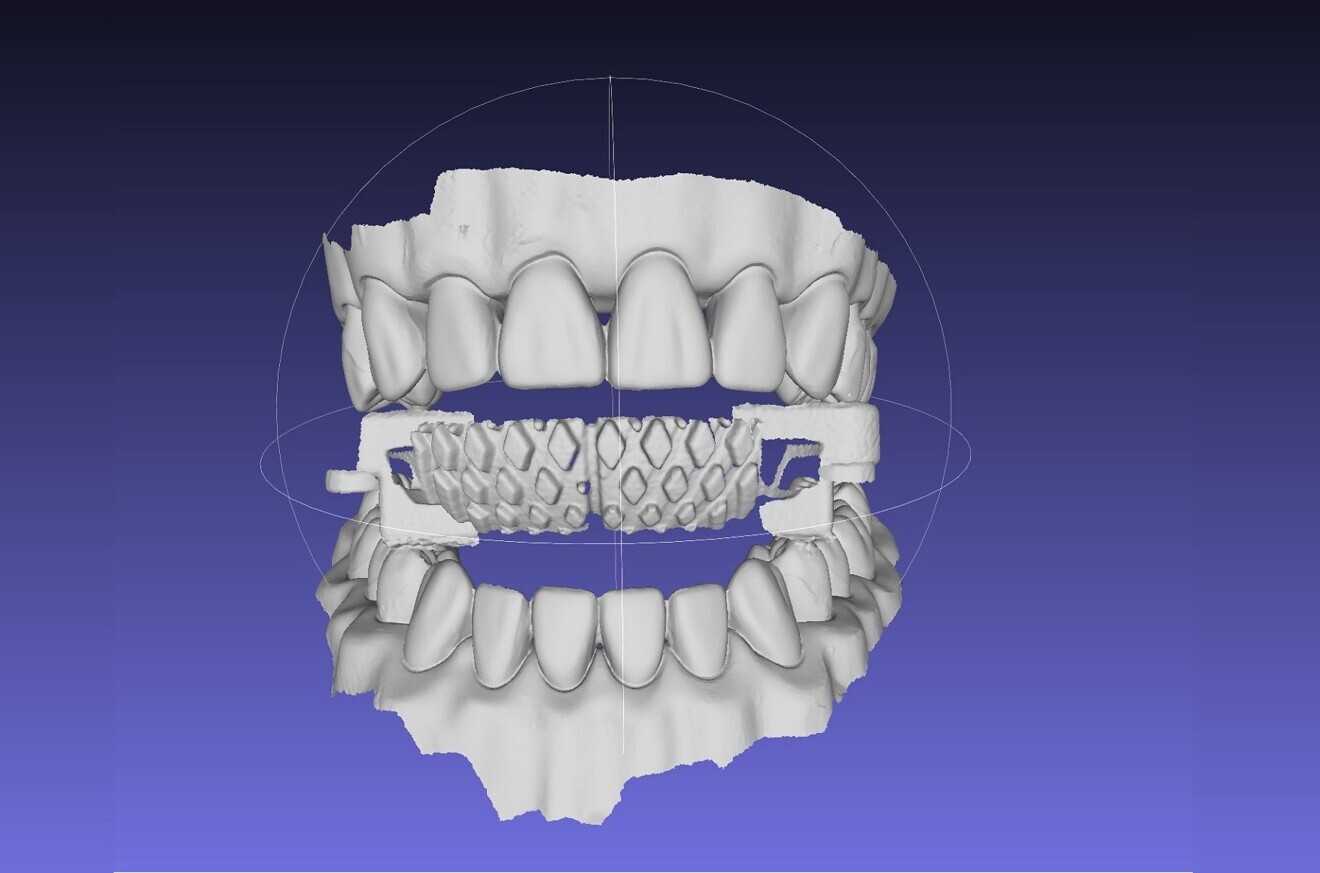 Fig. 4: Sample intra-oral scan with a bite block.