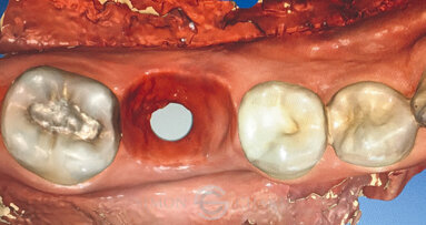 Výroba suprakonstrukce na implantát pomocí CERECu