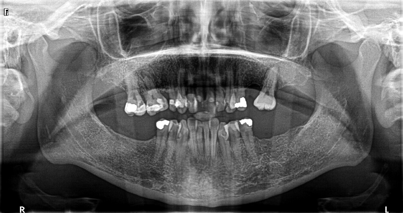 Fig. 3: Pre-op panoramic radiograph.