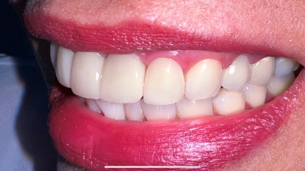 Fig. 7: Clinical photograph showing good adaptation of the coronal restoration, healthy periodontal tissue and a good aesthetic result. 