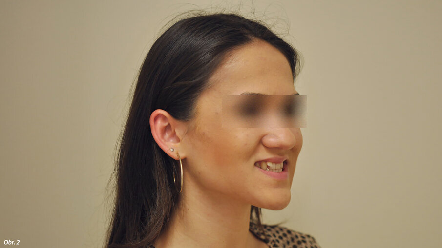 Extraorální fotografie počátečního stavu pacientky.