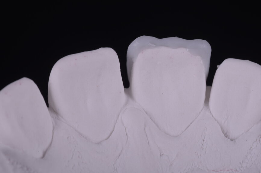 Fig. 27: Lingual view of the waxed up incisal edge.