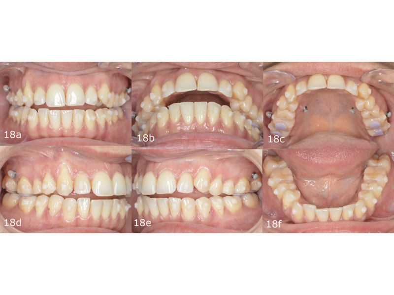 Figs. 18a–f: Pretreatment with the FAS Aligner System. Placement of attachments and skeletal anchorage.