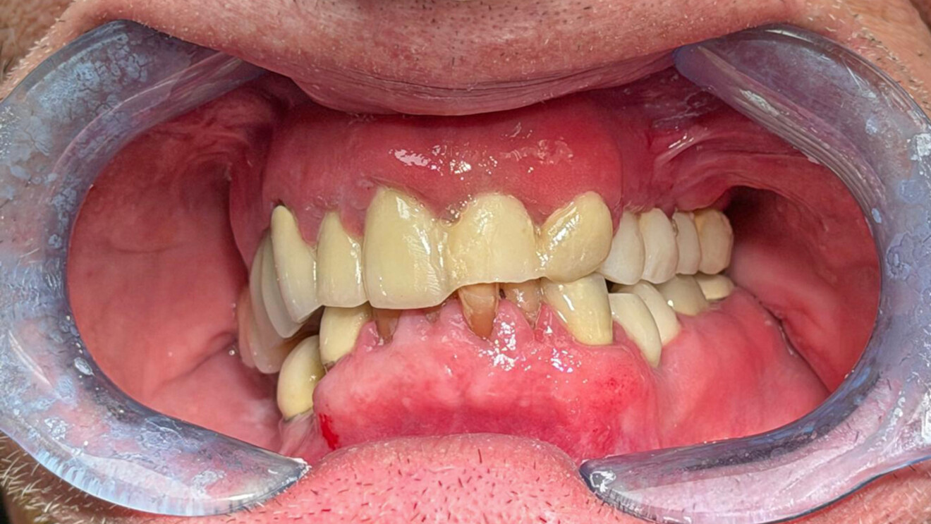 Fig. 1b: Retracted intra-oral oblique frontal view of the malocclusion, missing and fractured teeth, and uneven occlusal plane.