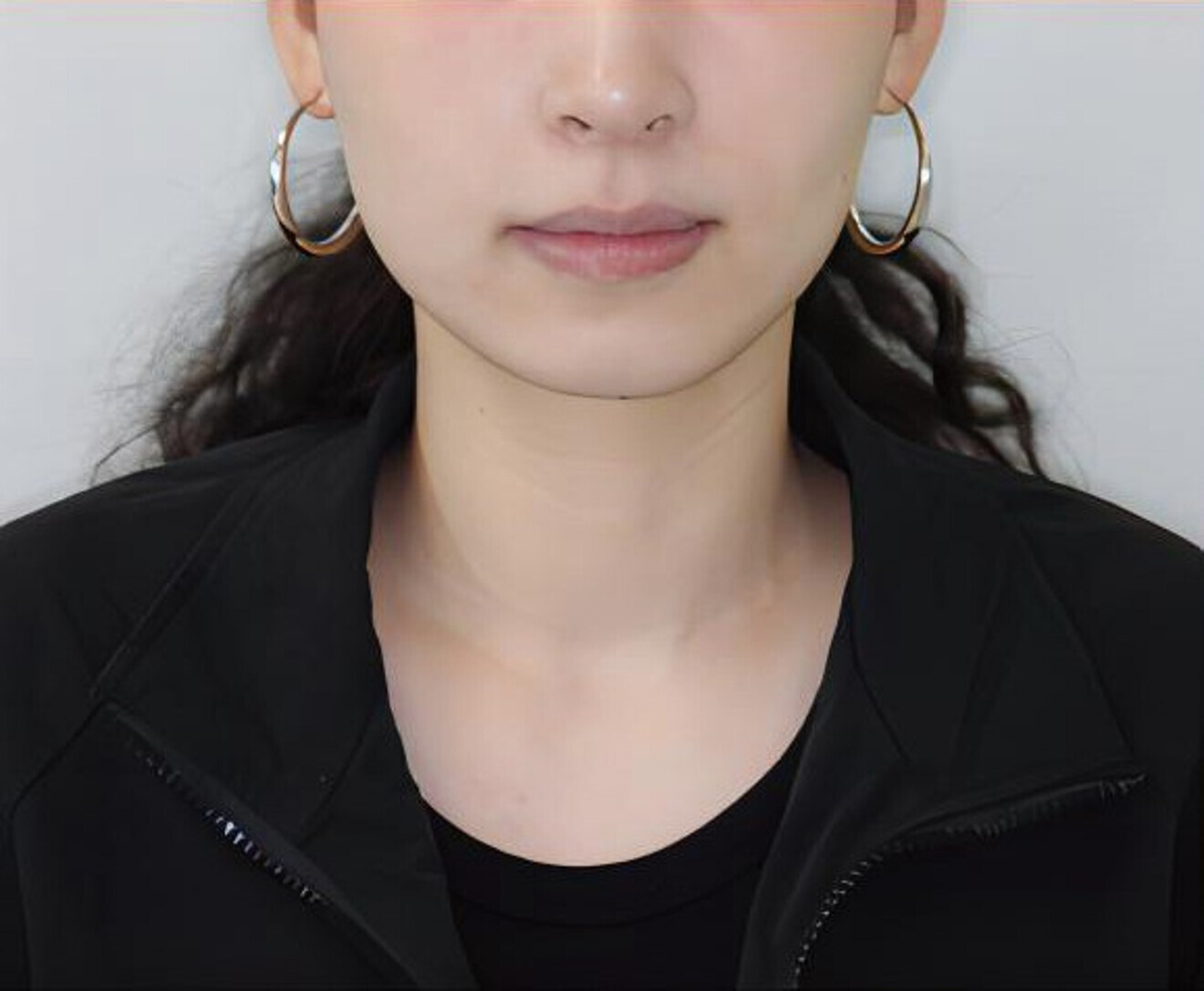 Fig. 4c: Frontal smiling view.  