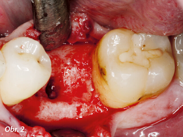 Po šesti týdnech nebyl alveol v oblasti meziálního kořene plně osifikovaný.