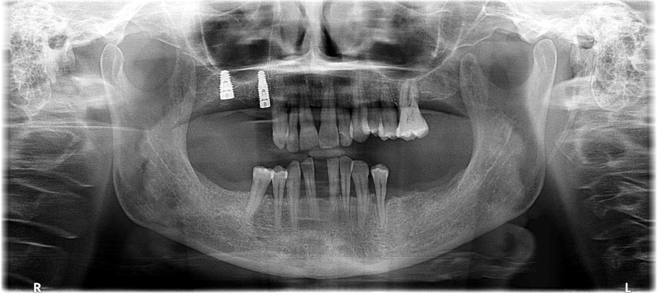 Fig. 3: Initial radiograph before treatment.