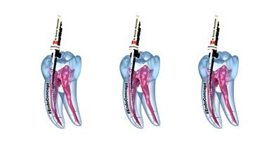 CHF technique prevents common endodontic mishaps