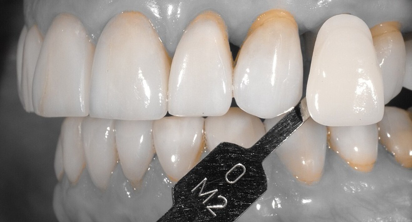 Fig. 1: Pre-op photograph taken with the EyeSpecial C-III (SHOFU Dental) to convey shade information to the ceramist.