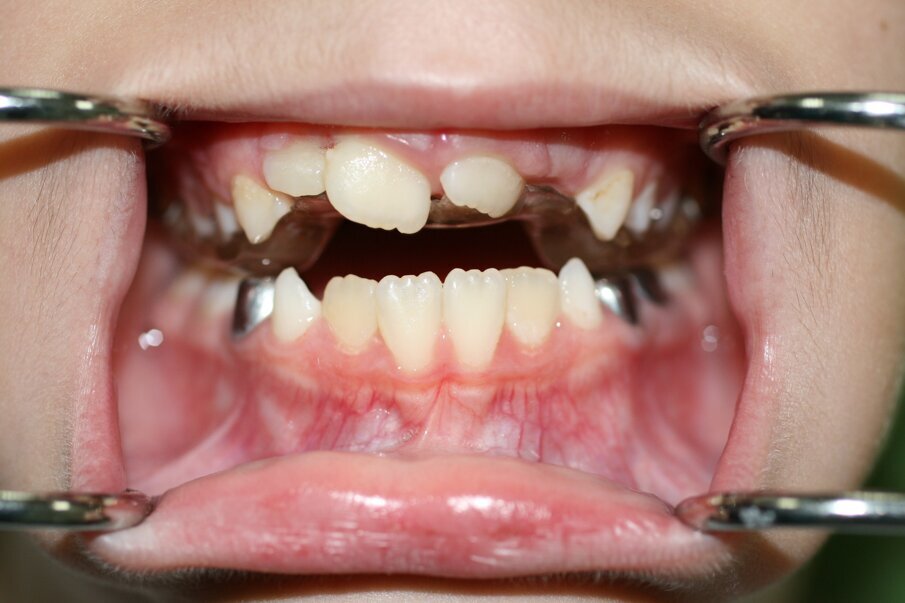 Fig. 14. The URA in place. Notice the posterior biteblocks opening the bite to facilitate the correction of the anterior crossbite.