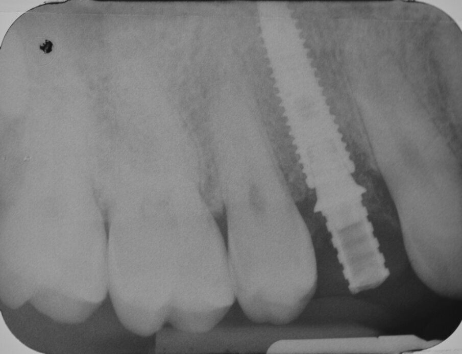 Fig. 18 - Esame radiografico endorale di controllo.