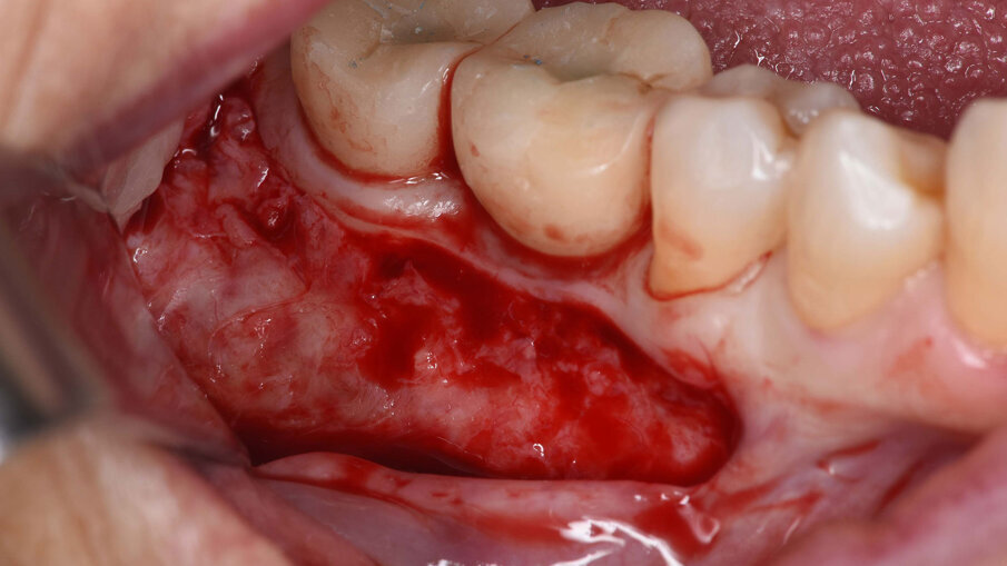 Fig. 13_Lembo a mezzo spessore per esecuzione di vestiboloplastica e innesto epitelio-connettivale.