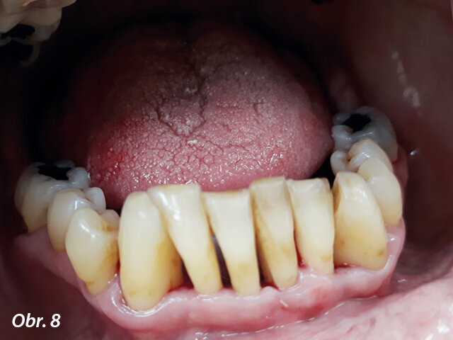 Obr. 8: Detail dolního frontálního úseku při recallu