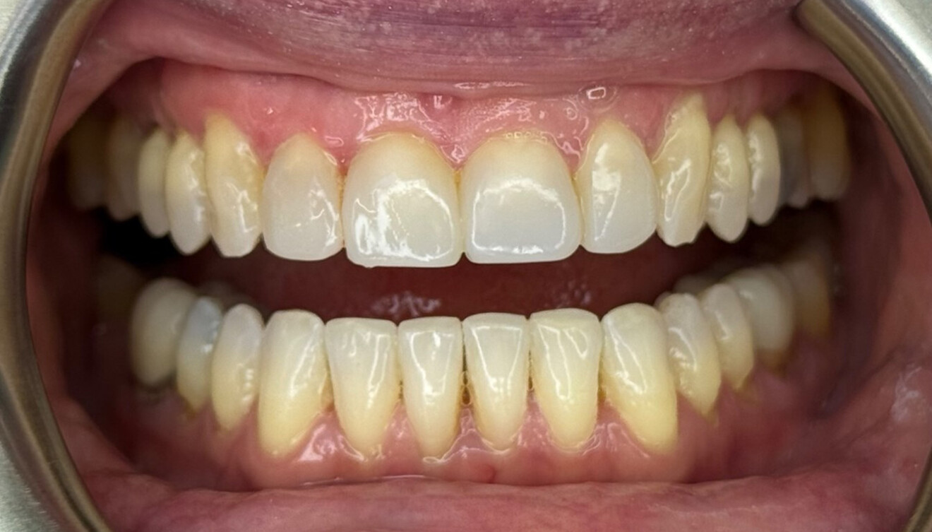 Figs. 6a–e: Intra-oral post-treatment photographs.