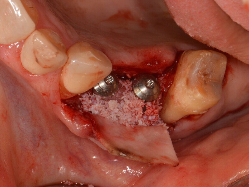 Fig. 13: Resorbable membrane and bone substitute material prior to wound closure.