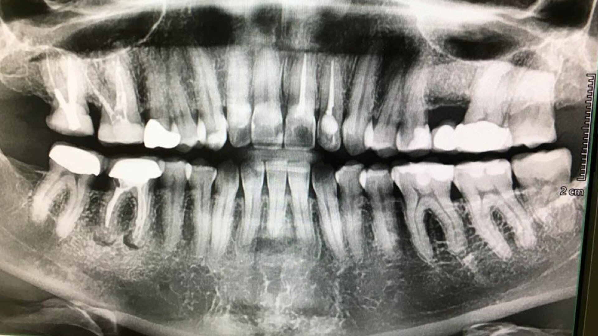 Diagnostic tips for bone lesions with DTX Studio Clinic