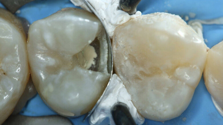 Figura 28. Se prepara una matriz preformada y un anillo interproximal.